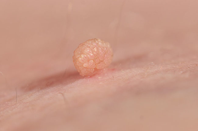 Skin Tags on Inner Labia